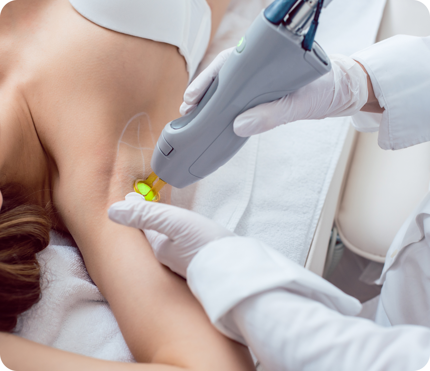  Full Body Laser Hair Removal 