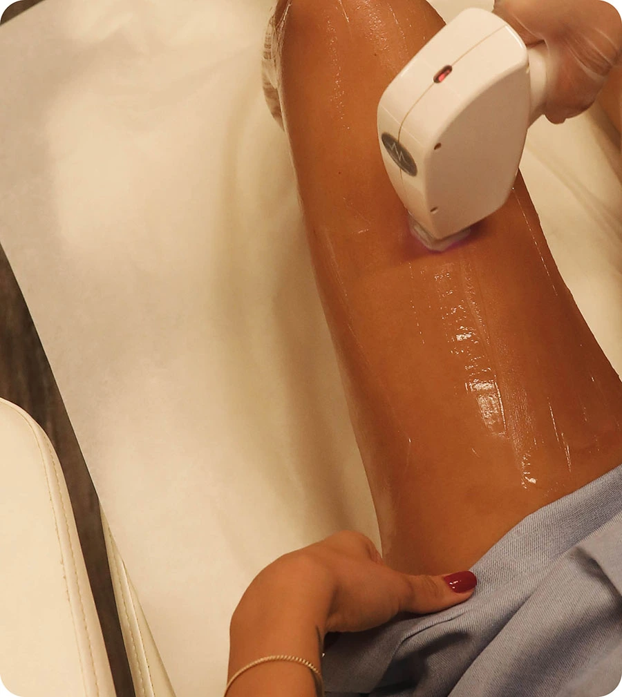 Benefits of Legs Laser Hair Removal Treatment